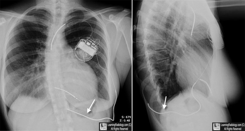 subcutaneous aicd lead, array